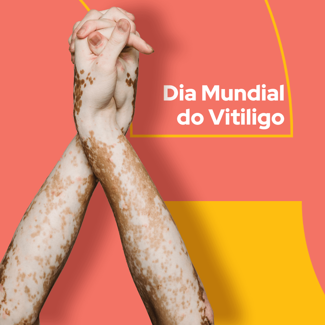 vitiligo